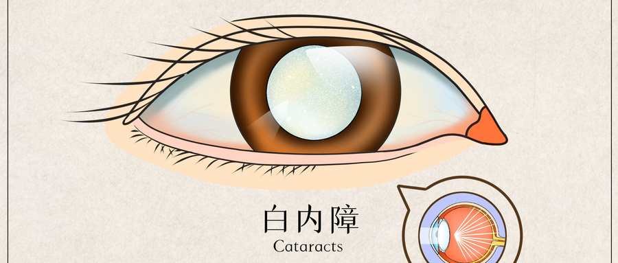 婴幼儿白内障术前评估与LOCS-UP分型方法及其应用的专家共识(2023)